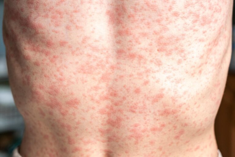 Texas health official warns against ‘measles parties’ amid pleas for more vaccinations – Dallas News